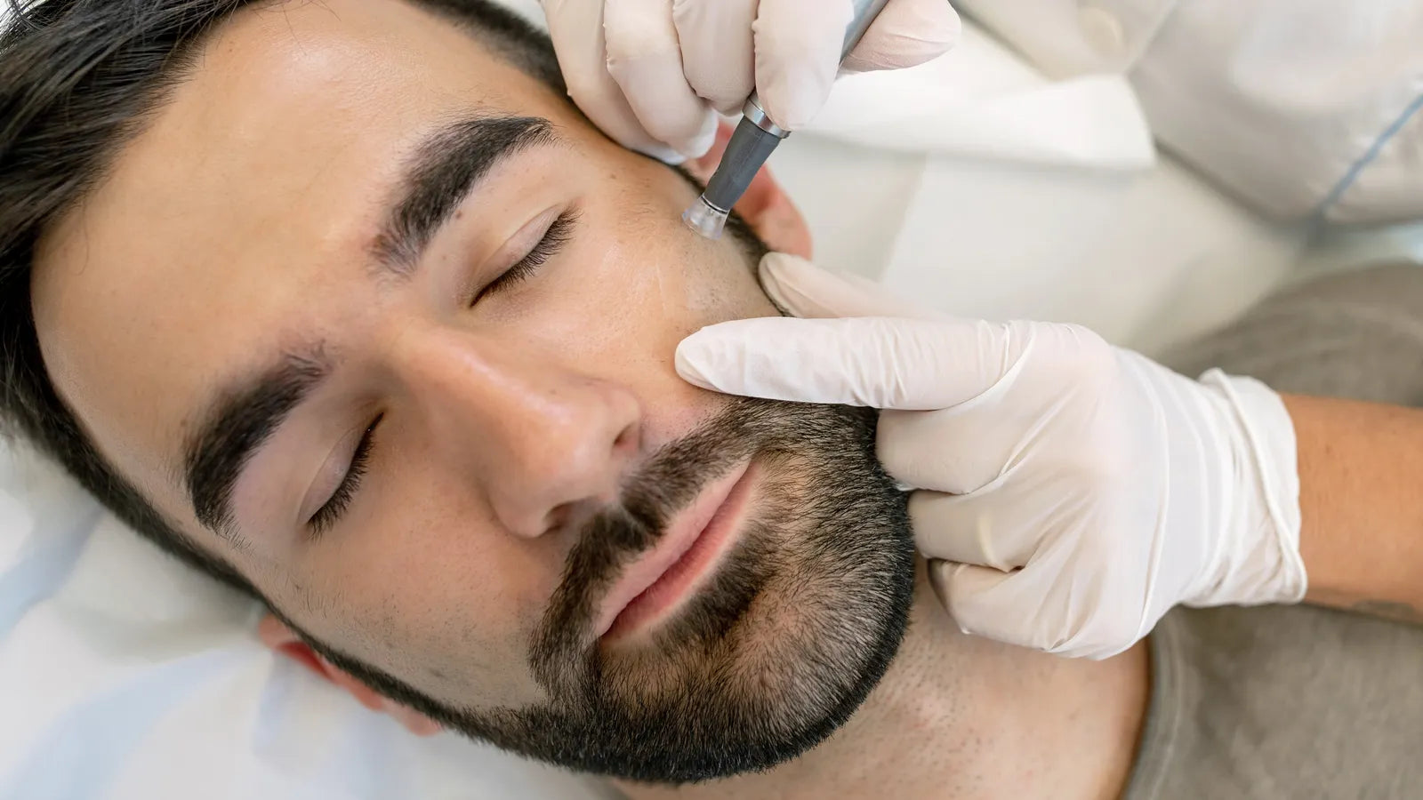 A man receives microneedling treatment on his face.