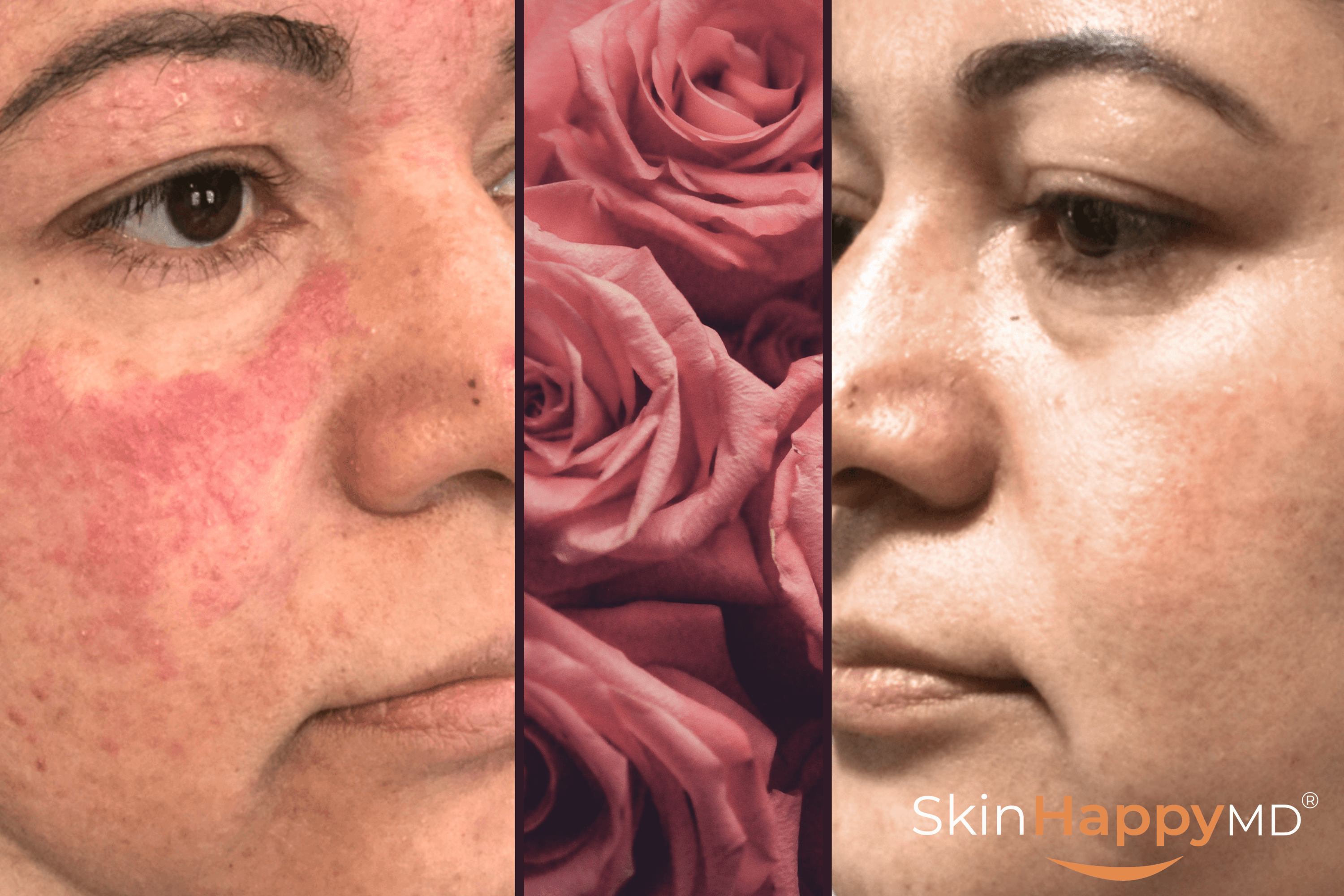 A before and after image of a woman with rosacea, with roses in between the photos.