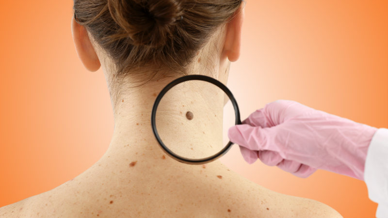 Skin Cancer is Surging in 2025. Are You at Risk?