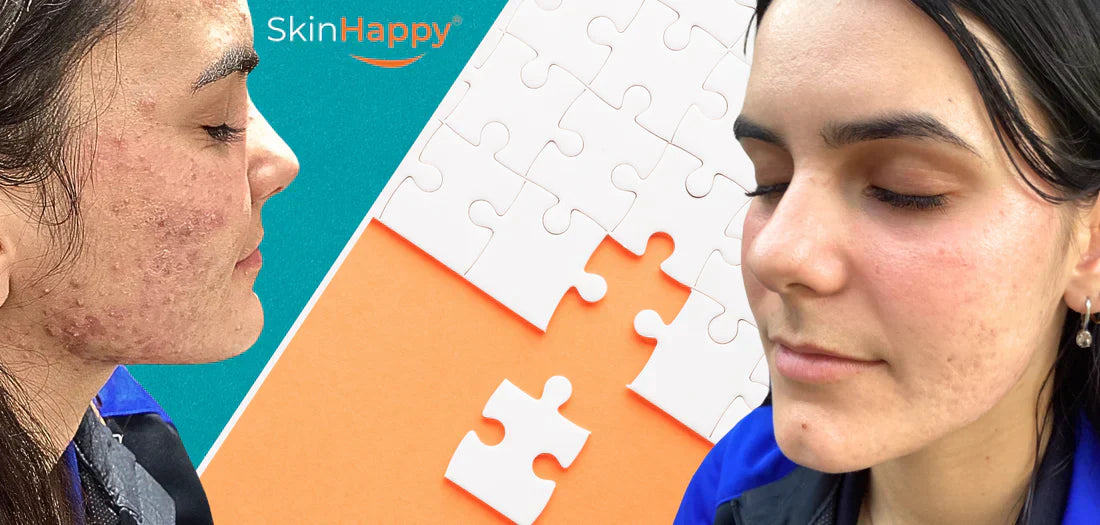 Why Should I See a Dermatologist For My Acne?