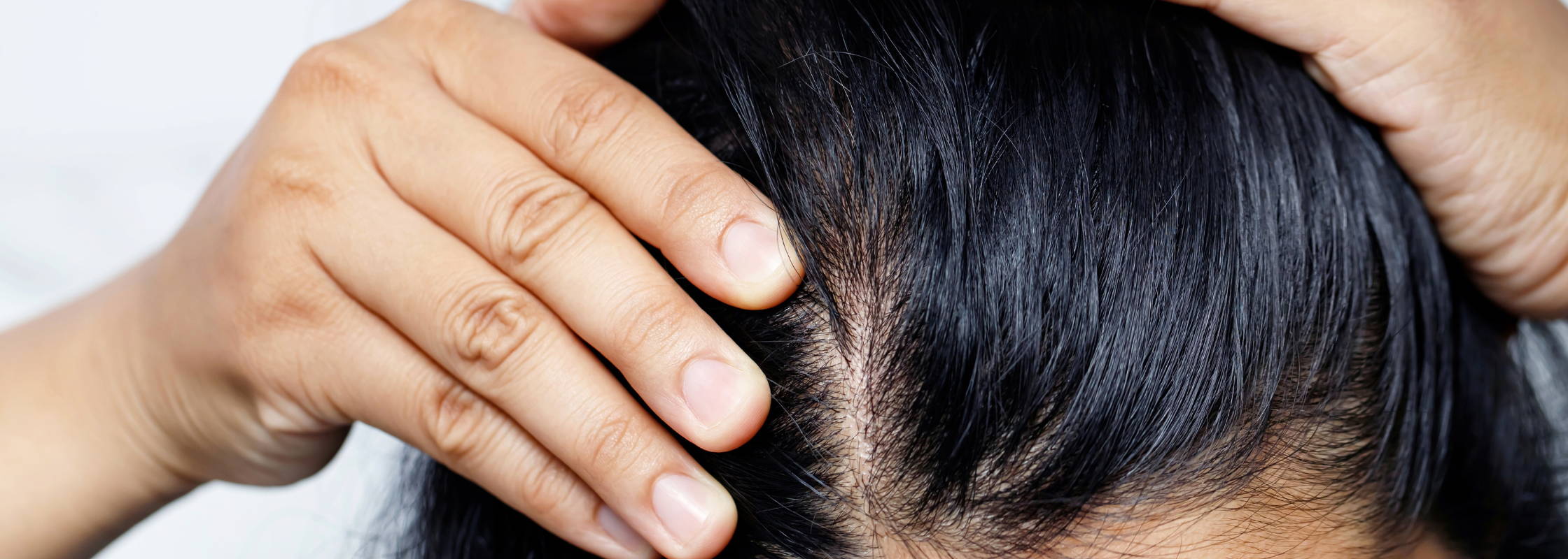 Treating Hair Loss: What You Need to Know