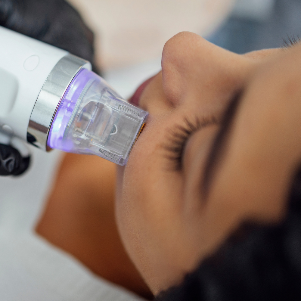 Microneedling