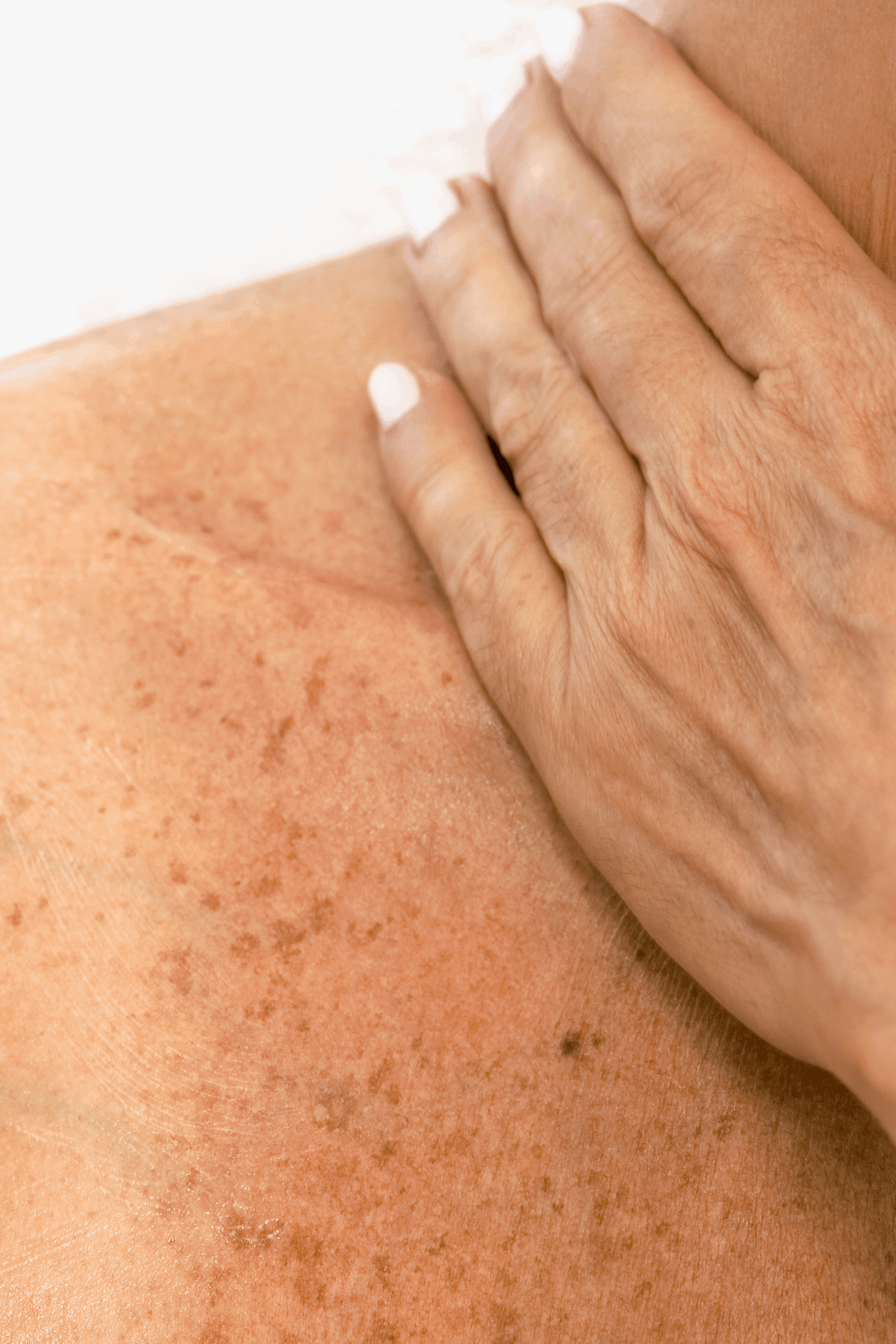 Skin Cancer Screenings