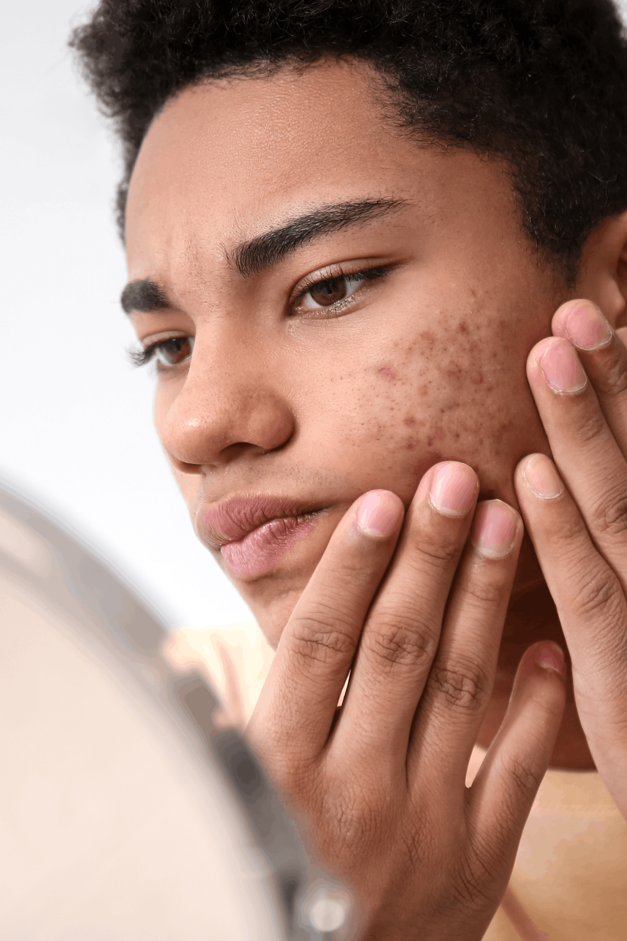 Acne Treatment