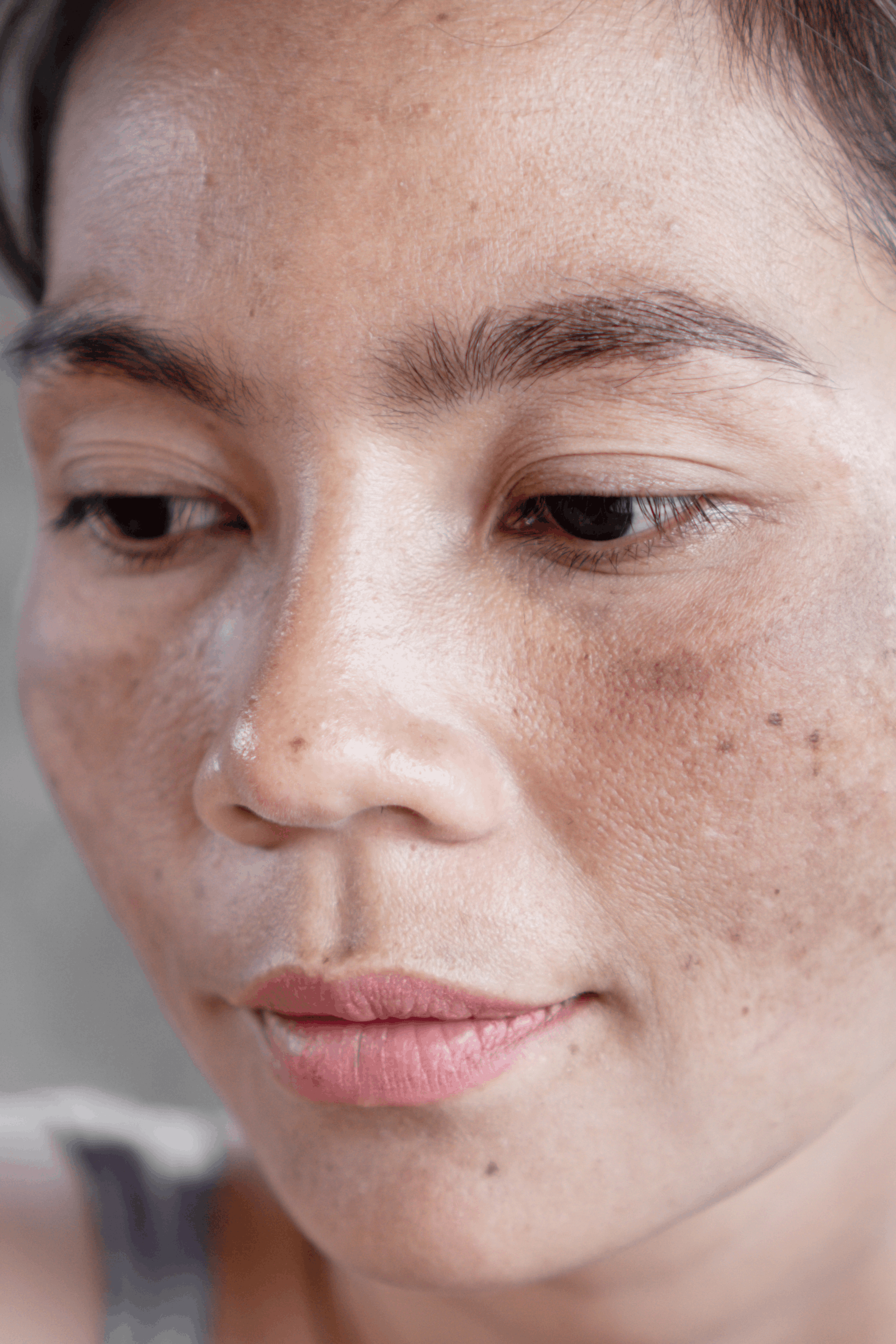 Facial Pigmentation