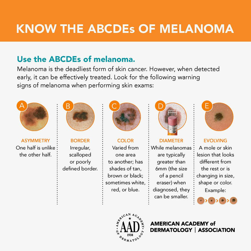 Infographic about the ABCDEs of melanoma with visual examples and text.