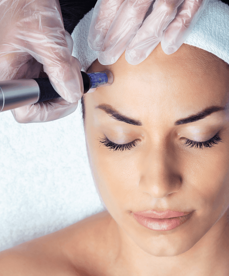 Person receiving a microneedling treatment on their forehead.