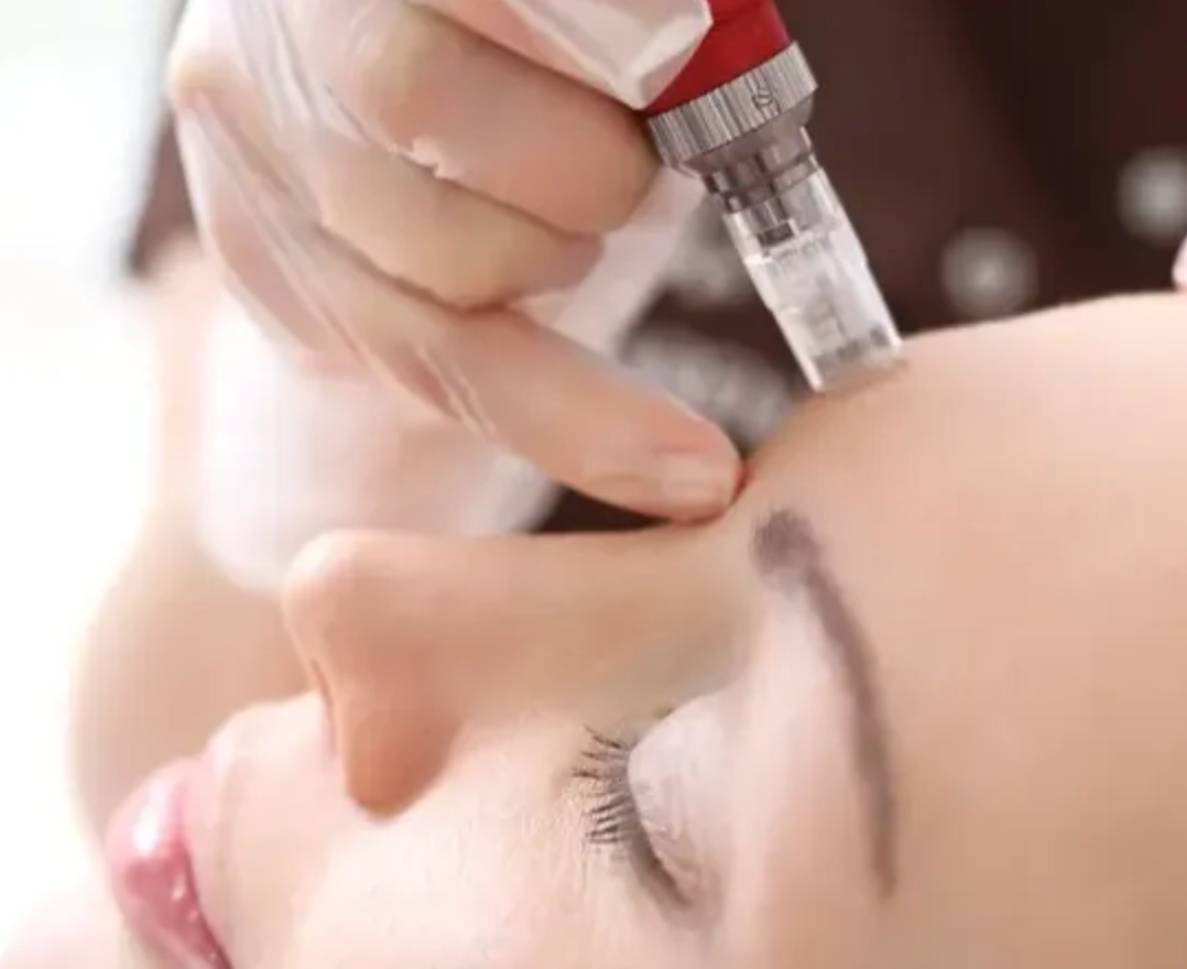 medical microneedling