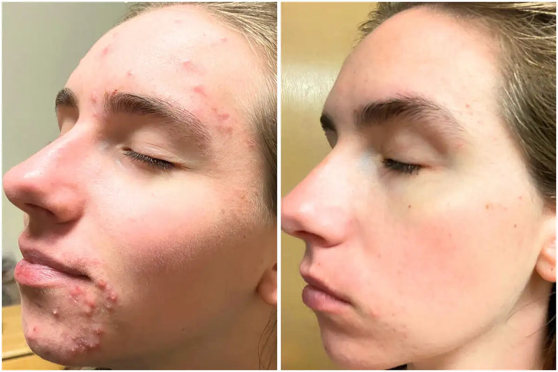 Before and after comparison of a person's face with acne