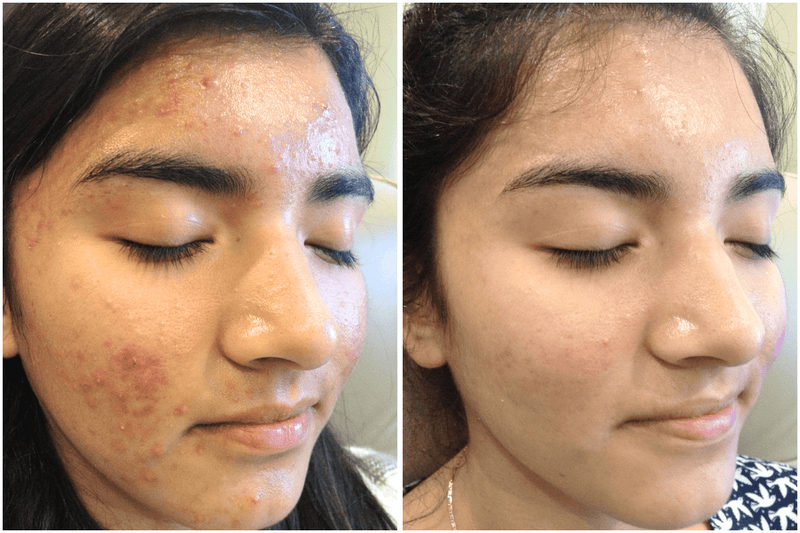 Before and after comparison of a person's face with visible acne on the left, and clearer skin on the right.