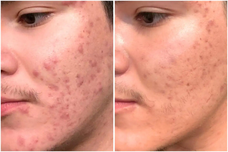 Before and after comparison of a person's face with acne treatment.