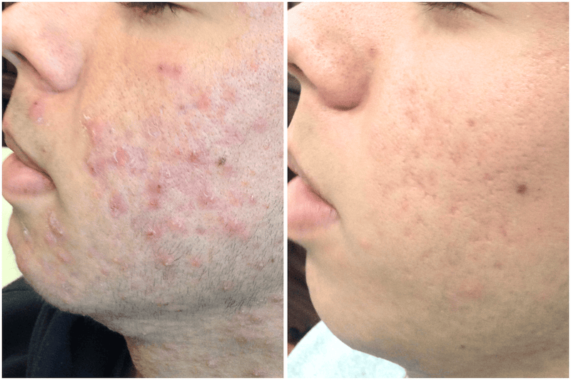 Before and after comparison of acne on a person's face.