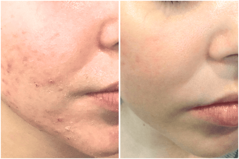 Before and after comparison of a person's face with acne on the left and clear skin on the right.