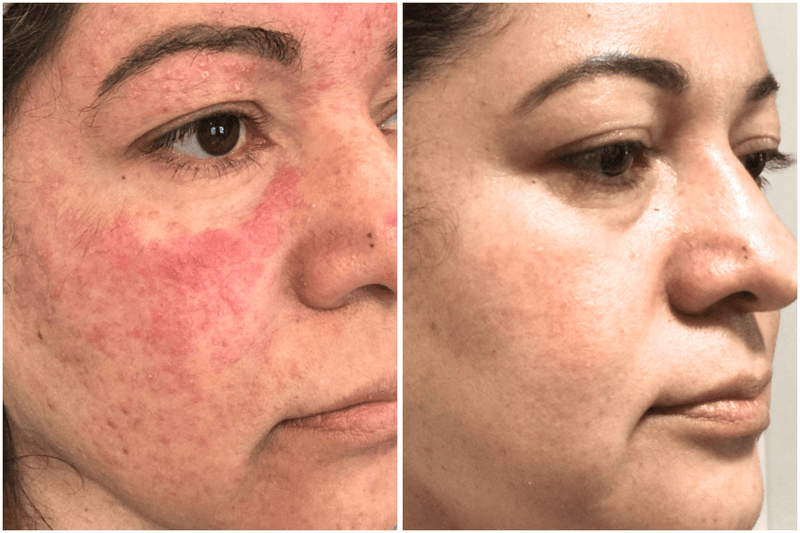 Before and after comparison of a person's face showing improvement in redness and texture.