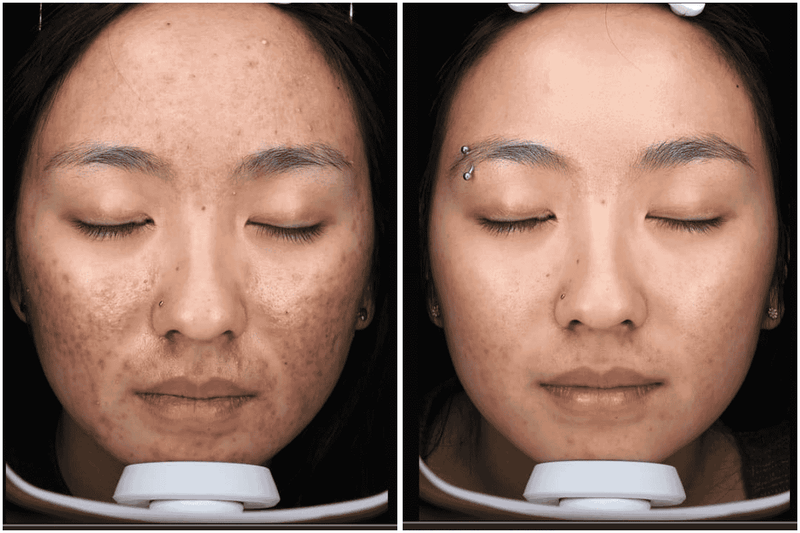 Before and after comparison of a person's face with closed eyes, showing skin texture and color improvement.
