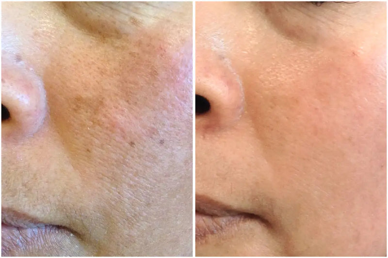 Before and after comparison of a person's skin on the cheek and nose area showing improvement in tone and texture.