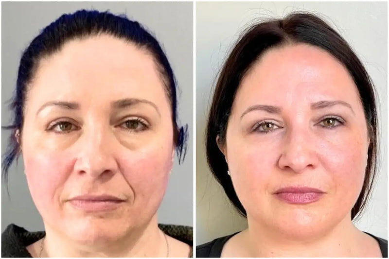 Side-by-side comparison of a woman's face before and after a treatment.