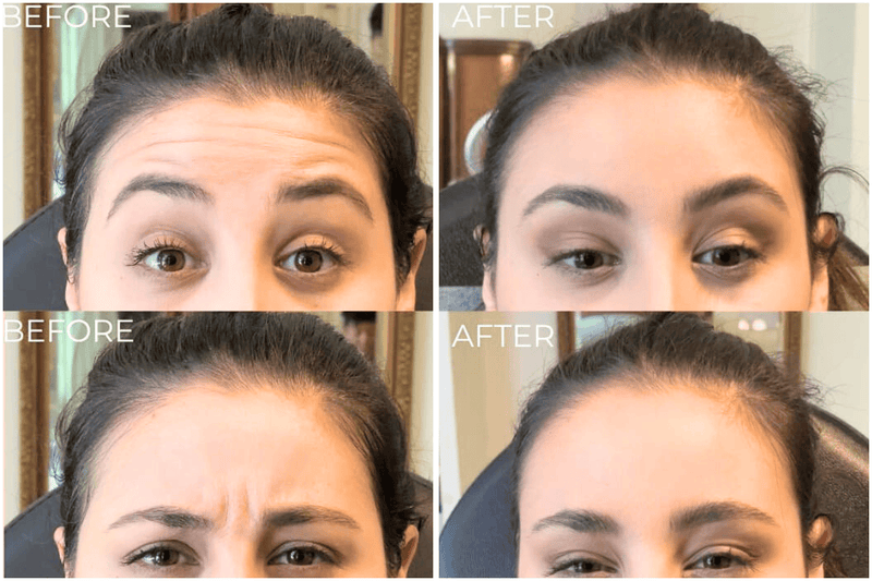 Side-by-side comparison from several views of a woman's face before and after a procedure.