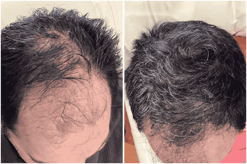 Before and after comparison of hair restoration treatment on a person's  crown.