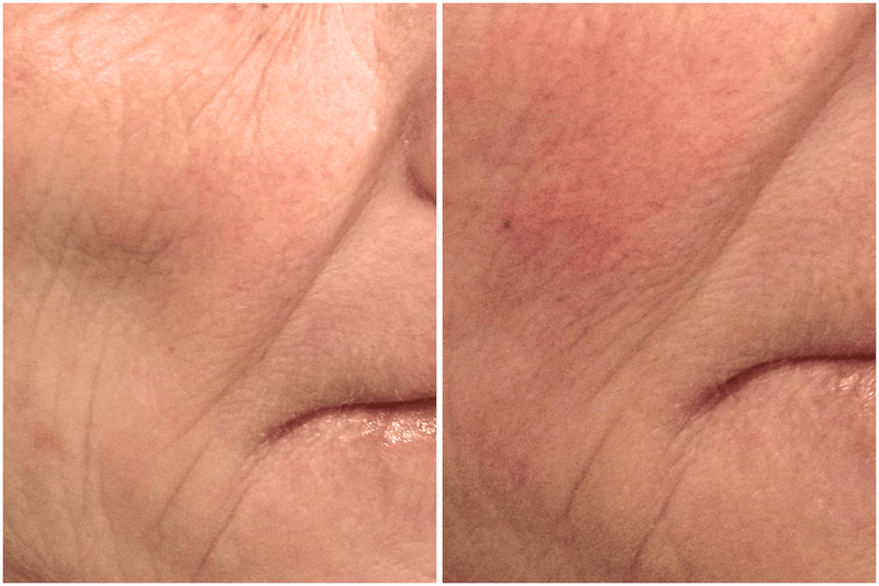 Before and after comparison of a person's face after a filler procedure.