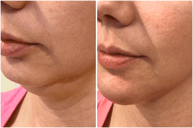 Before and after comparison of a woman's lips