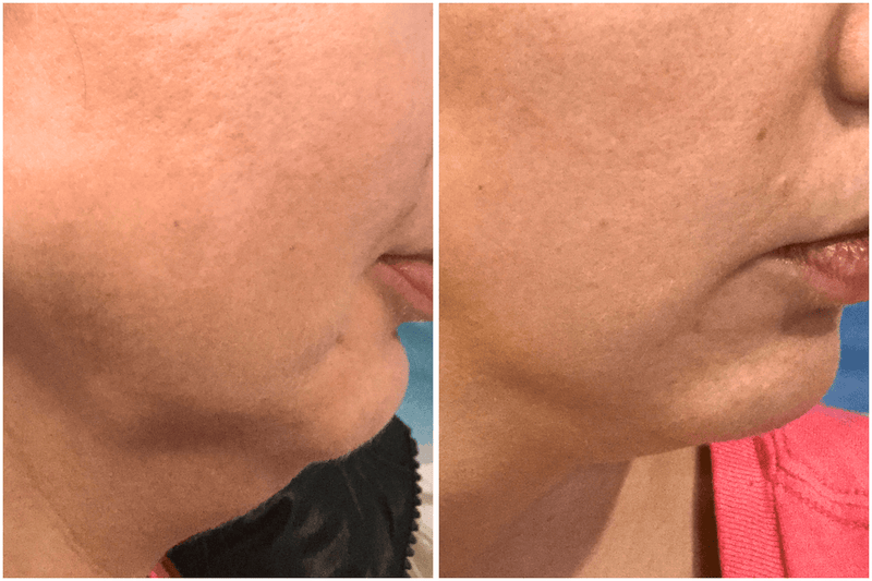 Side-by-side comparison of a person's neck area before and after a treatment.