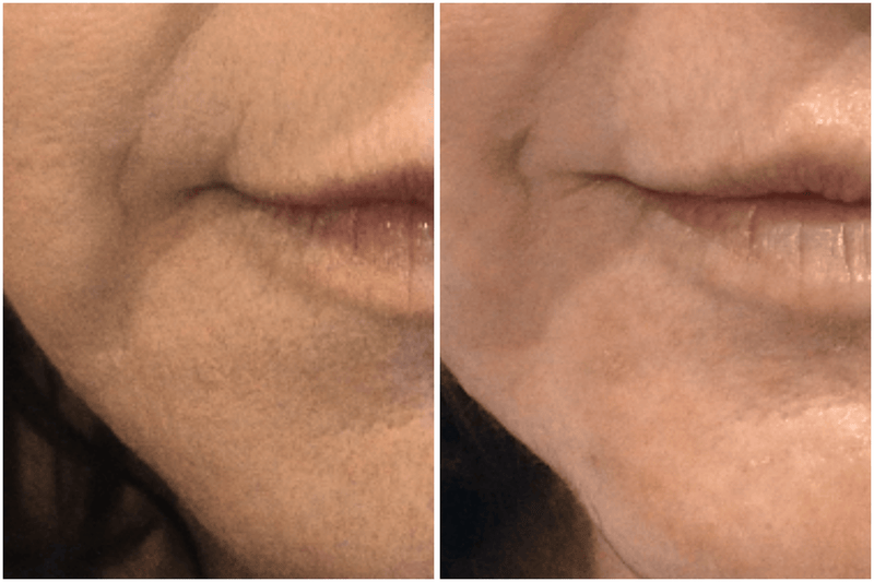 Side-by-side comparison of a person's lips with and without a lip filler procedure.