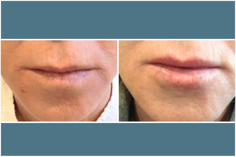 Before and after comparison of lips after a filler procedure.
