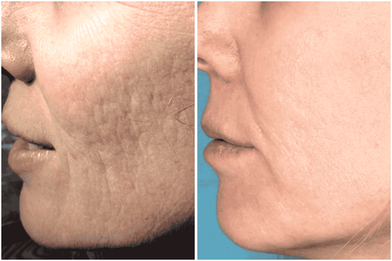 Before and after comparison of a person's face showing improvement in visible skin texture and lines.