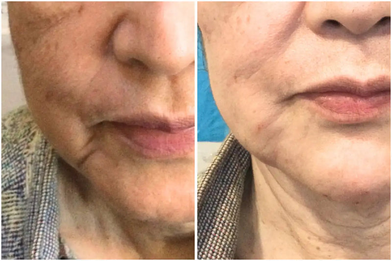 Before and after comparison of a woman's lips showing improvement in visible aging changes.