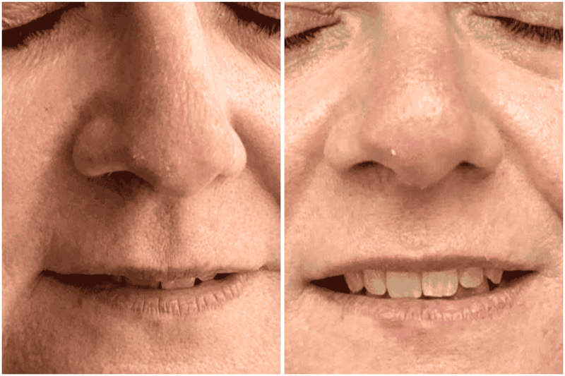 Before and after comparison of a person's nose following a treatment.