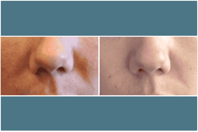 Before and after comparison of a nose showcasing difference in pore size.