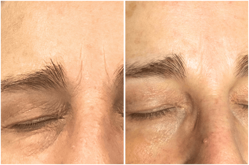 Side-by-side comparison of a person's eye with and without a treatment, showing the effect on skin texture.