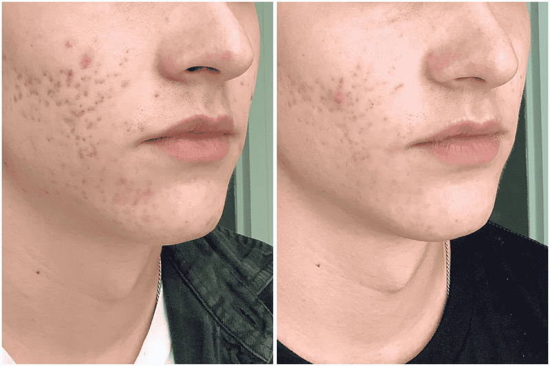 Before and after comparison of a person's face with acne on the left and clearer skin on the right.
