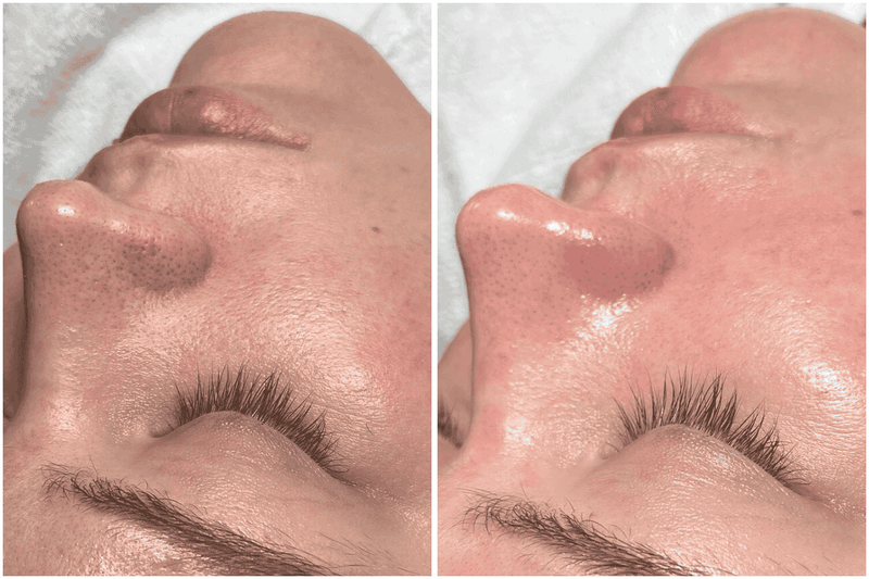 Before and after comparison of a person's face showcasing clean pores and smooth, shiny skin.