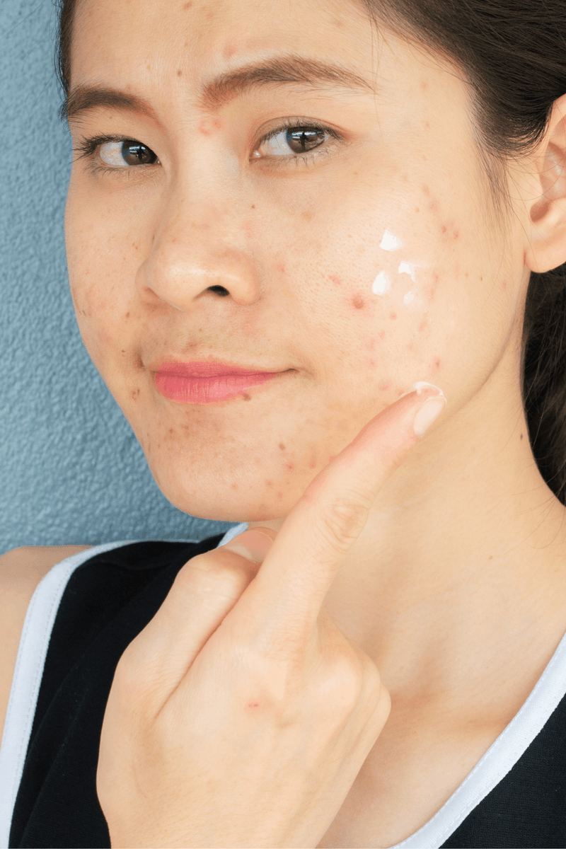 A woman with acne applies a cream to her face.