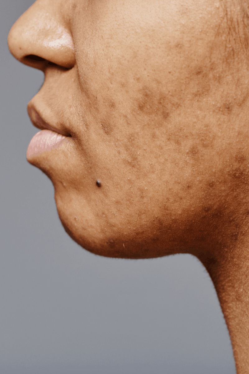 A person with acne scarring on their cheek.