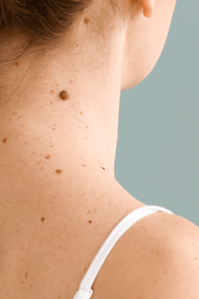 A person's neck showing moles and freckles.