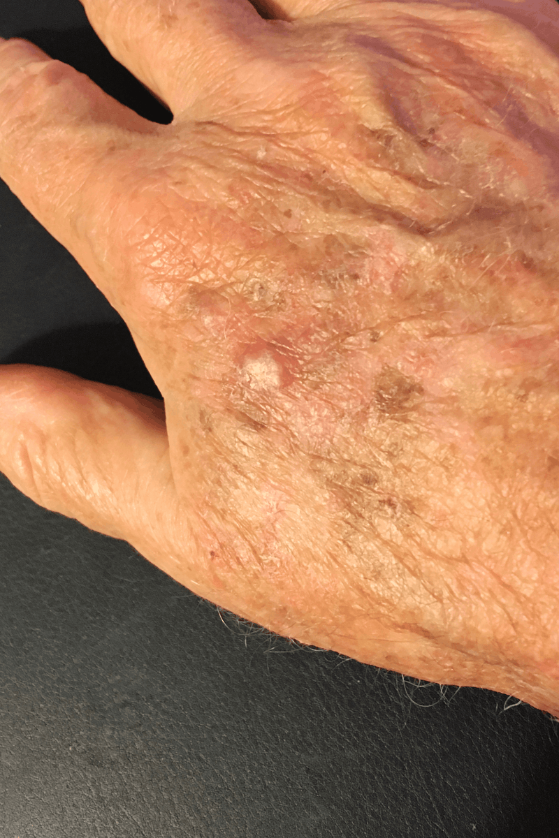 Actinic keratosis on a person's hand.