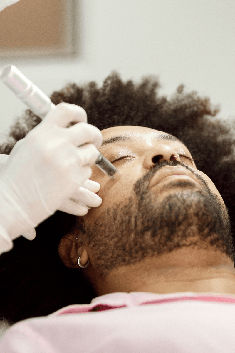 A a man receives microneedling treatment on his cheek.